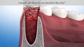 Tratamiento de conservación del hueso tras una extracción dental [upl. by Ralston]