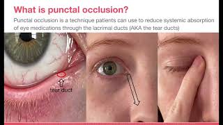 Punctal Occlusion [upl. by Cordy]