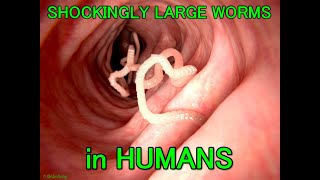 Shockingly Large WORMS in HUMANS [upl. by Duval85]