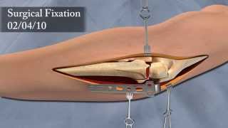 3D Surgical Animation of Elbow Injury [upl. by Matejka481]