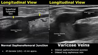 Saphenous Vein Doppler Ultrasound Normal Vs Abnormal  Varicose Veins  Lower Limb Vascular USG [upl. by Arnulfo474]