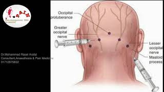 Greater Occipital Nerveblock  GreateroccipitalnerveHeadacheneckpain NeuralgiaPainfixRx [upl. by Notlih489]