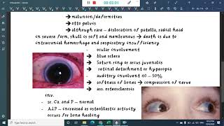 osteogenesis imperfecta  Orthopedics [upl. by Linnie]