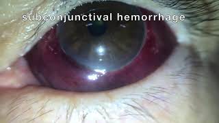 Subconjunctival hemorrhage hyposphagma [upl. by Riek]