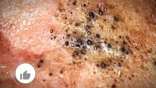 Most Satisfying CloseUp Blackhead Removal 2024 [upl. by Belsky255]