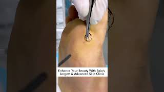 How To Remove Plantar Warts Understanding Treating and Preventing Foot Warts skinaaclinic [upl. by Waite]