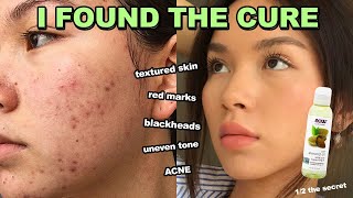 How to fix ACNE RED MARKS ampTEXTURED SKIN in 1 week it works [upl. by Raybin]