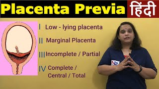 Placenta Previa in Hindi  APH Antepartum HemorrhageTypes Risk factors Symptoms  Nursing Lecture [upl. by Snave]