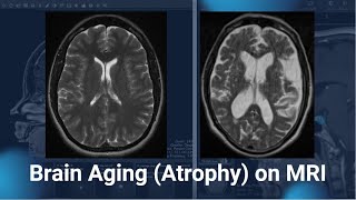 Brain Atrophy on MRI [upl. by Ylsew993]