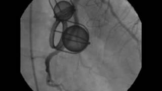 Two Views of the StarrEdwards Valves during Cardiac Catheterization [upl. by Hoxsie]