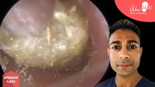 1092  Fully Blocked Ear Wax amp Dead Skin Removal [upl. by Clarinda564]