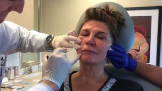 Botox Radiesse Restylane RefynePinski Dermatology and Cosmetic Surgery Chicago [upl. by Nonahs]