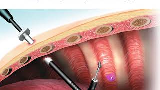 bronchoscopy colonoscopyالمناظير هضمي منظار بطن وصدر ومنظار العظام والركبه والكتف والقولون [upl. by Nicolis364]