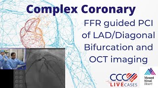 FFR guided PCI of LADDiagonal Bifurcation and OCT imaging  CCC Live April 2016 [upl. by Aihsoem355]