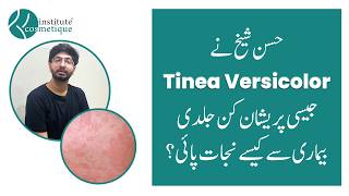 From Struggle to Relief 8Year Tinea Versicolor Recovery Story  Cosmetique [upl. by Ettesoj]