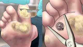 Satisfying foot wart treatment  screw nail removal  tingle sound [upl. by Ailaroc]