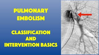 PE Classification amp Intervention Basics [upl. by Nahta922]