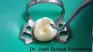 Curación Dental con resina Parte 1  PermaSeal Ultradent [upl. by Burack]