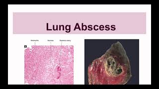 Lung Abscess [upl. by Nnairac]