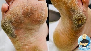 EXTRA THICK HARD SKIN REMOVAL TREATMENT CRAZY BIG CALLUS [upl. by Grubb]