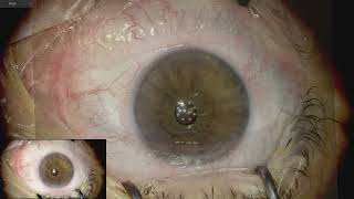 Ngenuity 15 astigmatic guidance for paired incisions Lukan Mishev live stream [upl. by Araj618]