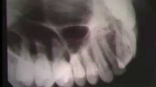 Occlusal Radiography [upl. by Ynatsyd]