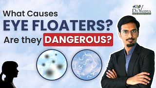 What are EYE FLOATERS Causes Risks amp Treatment  Vitrectomy  Dr Harshit Vaidya [upl. by Luane]