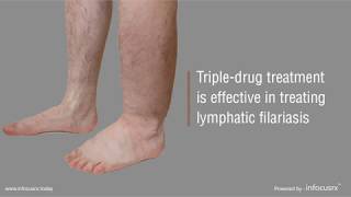 Tripledrug treatment is effective in treating lymphatic filariasis [upl. by Lleumas]