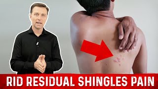 Get Rid of Shingles Pain Fast – DrBerg [upl. by Viridissa439]