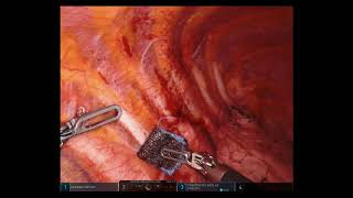 Catamenial Pneumothorax RoboticAssisted Surgical Treatment [upl. by Alonzo975]