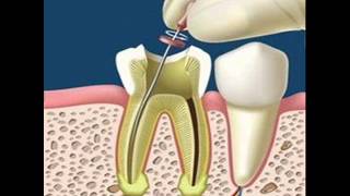 Absceso alveolar crónico Diagnóstico y tratamiento [upl. by Franciscka]