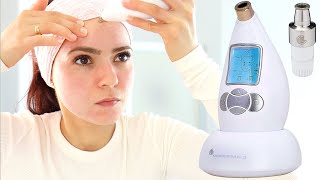 Microderm Glo Review amp How To Use  Microdermabrasion DIY Facial Treatment For Clear Skin [upl. by Enialehs774]