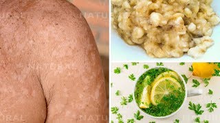 3 Natural Remedies for Treating Tinea Versicolor at Home Pityriasis Versicolor [upl. by Notlrak]