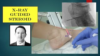 Injection  navicular cuneiform CSI under Xray guidance [upl. by Whetstone567]