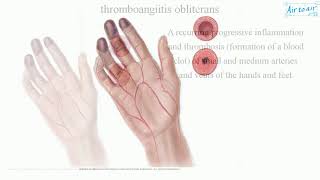 thromboangiitis obliterans [upl. by Eseret]