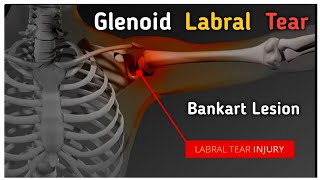 Glenoid labrum tear  Bankart lesion labraltear shoulderdislocation shorts [upl. by Noiro767]