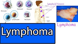 Lymphoma  Types Most common Lymphomas Symptoms and treatment [upl. by Jorgenson851]