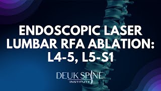 Endoscopic Laser Lumbar RFA Ablation L45 L5S1 [upl. by Artenehs991]