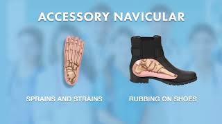 What is Accessory Navicular  Ask Dr Silverman [upl. by Gavra]