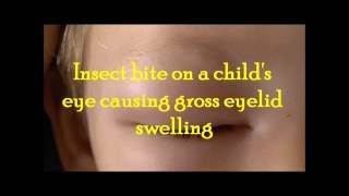 Gross eye swelling on a child following an insect bite and treatment [upl. by Phemia]