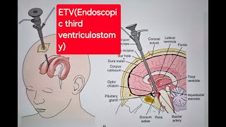 ETV endoscopic third ventriculostomy for Hydrocephalus  Dr Ravi Kumar  Neurosurgeon [upl. by Linskey]