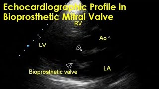 Echocardiographic profile of bioprosthetic mitral valve [upl. by Conchita43]