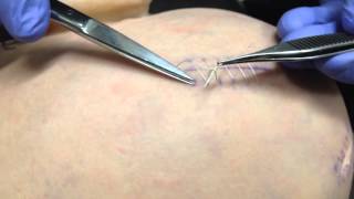 How to remove a running suture [upl. by Stilla243]