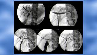 16 Radiologia interventistica delle vie biliari Paolo Fonio [upl. by Atirihs324]