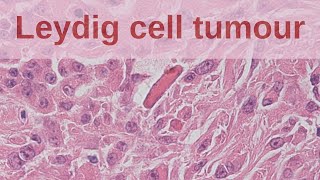 Leydig Cell Tumours of the Testis  Pathology mini tutorial [upl. by Yerggoeg]