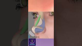 Augmentation Rhinoplasty Surgery 3D animation [upl. by Nah]