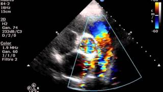 Persistencia de Conducto Arterioso [upl. by Anirb]