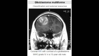 Glioblastoma Multiforme grade IV astrocytoma  Most Common Primary Brain Tumor [upl. by Latsyc]