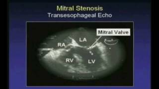 Rheumatic Mitral Stenosis  Transesophageal Echocardiogram [upl. by Ohce]