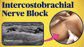 Ultrasound and Landmarkbased Intercostobrachial Nerve Block [upl. by Vada]